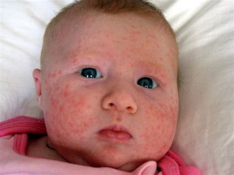 health rashes