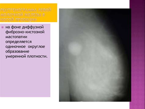Лучевая диагностикка заболеваний молочной железы - online presentation