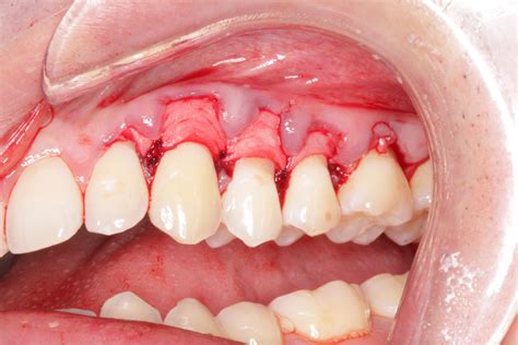 Thinking About Specializing in Periodontics and Implant Surgery