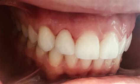 Individualized Composite Resin Cosmetic Filling | Dentist 95032