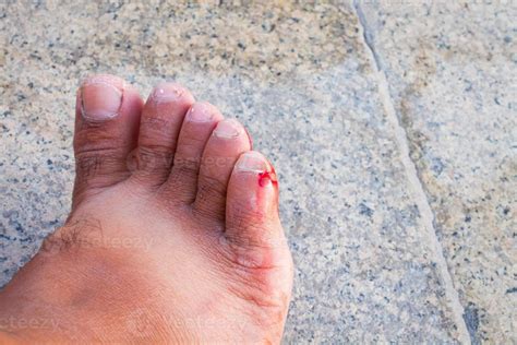Calo De Sangue No Pé - ferida com sangue incisada no pé de um homem 3088915 Foto de stock no ...