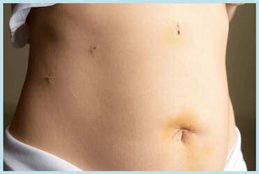 Hysterectomy Scar Pictures & Incisions From Different Techniques