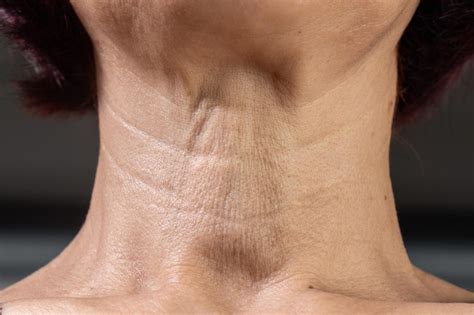 neck lines   treatment