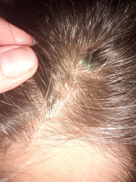 Large, hard kind of scaly bumps all over husband's head... have been