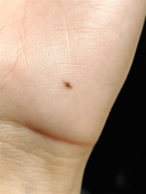 What Does A Beauty Mark On Your Ring Finger Mean at Michael Stover blog