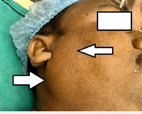 Right parotid gland swelling immediate post surgery. | Download ...