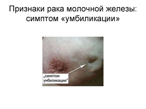 Рак молочной железы - презентация онлайн