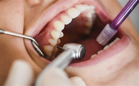 como ocorre  formacao  calculo dental dabi atlante