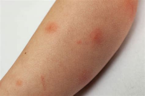 Mosquito Bite Swelling Stock Photos, Pictures & Royalty-Free Images - iStock