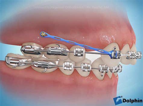 orthodontic tad kit  dorothy boots blog