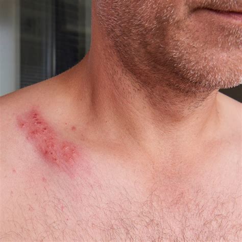post herpetic neuralgia phn forces  nature medicine
