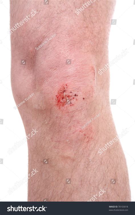 Scraped Knee Stock Photo 78103018 - Shutterstock