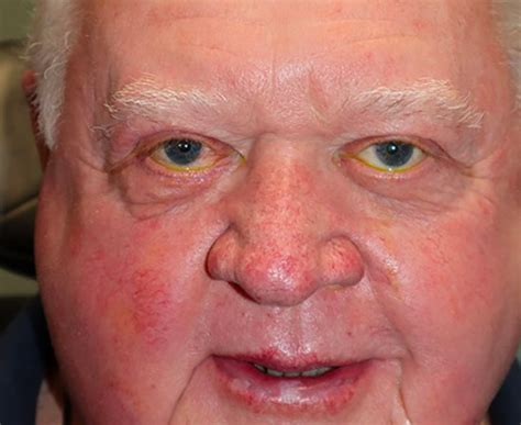 ectropion oculofacial surgery  cosmetic laser institute lutz fl