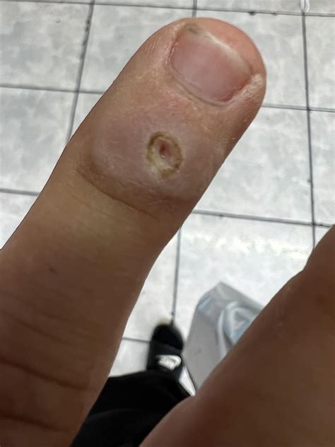 I just got rid of Plantar Wart on my finger using ACV for 2 weeks. I’ve