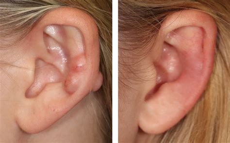 Piercing Bump Keloid: How To Tell The Difference And What, 43% OFF