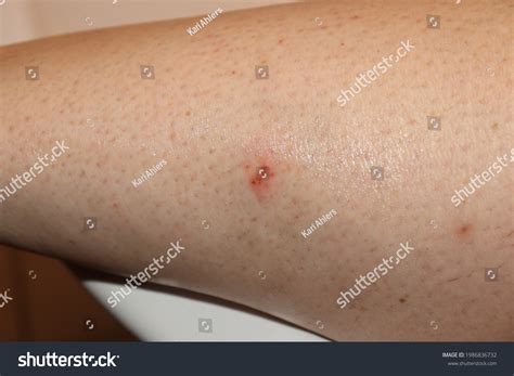 snake bite   womans leg stock photo  shutterstock
