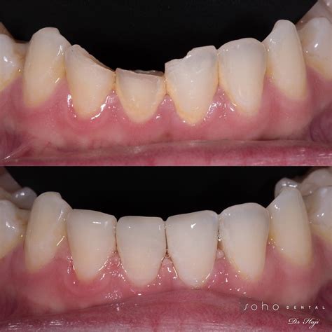 Bonding to Restore Fractured Tooth - Soho Dental - Toronto Dentist