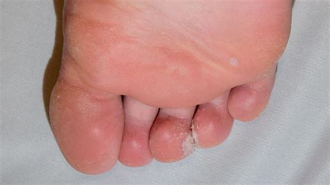 mosaic warts symptoms  treatments