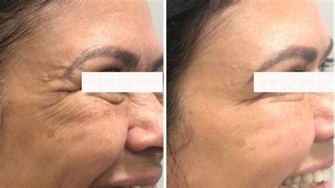 Antes E Depois Do Botox No Rosto - Botox no Rosto: Antes e Depois - Fotos Reais, Pré e Pós Cirurgia