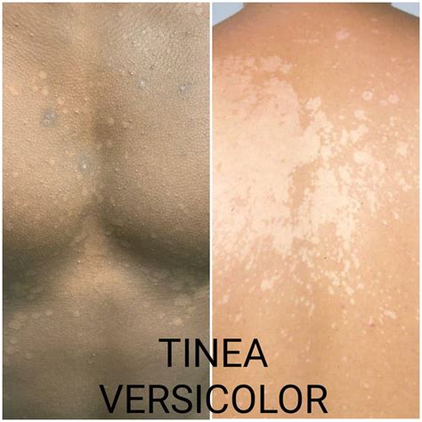 Tinea Versicolor Before And After