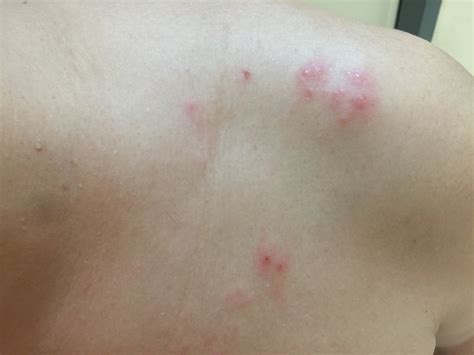 What Does Staph Look Like BJJ?