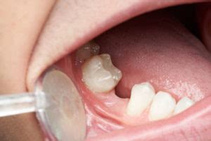 Broken Tooth Extraction - Niyama Care Dental