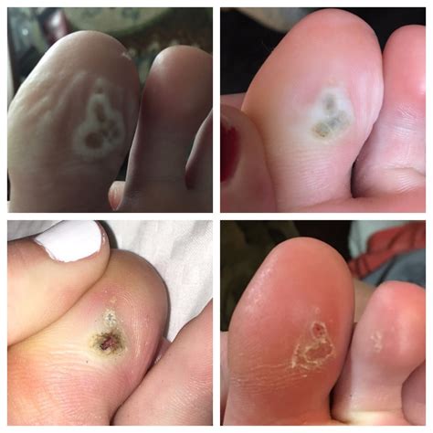 Stages Of Plantar Wart Removal - Plantar Wart Removal Duct Tape : When