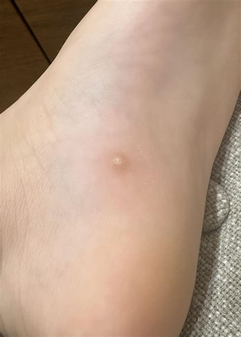 Help identifying wart : r/Warts