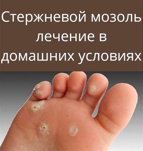 Стержневой мозоль лечение в домашних условиях | Лечение, Факты о ...