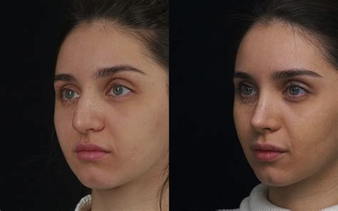 Ринопластика