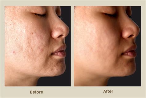 BioRevitalization Peel PRX-T33 Newport Beach | PCH MedSpa