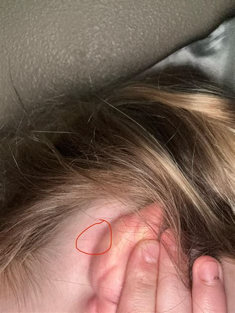 Very Small, Hard round Lump behind ear, under the skin 100% not a