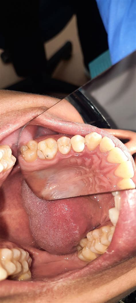 Does this caries ( both pics) require urgent care ? how dangerous is it