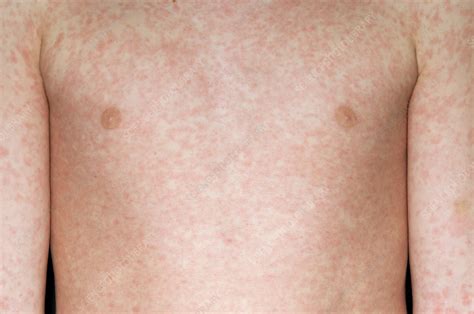 Measles rash - Stock Image - M210/0364 - Science Photo Library