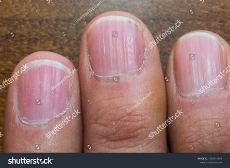 Vertical Ridges On Fingernails Symptoms Deficiency Stock Photo