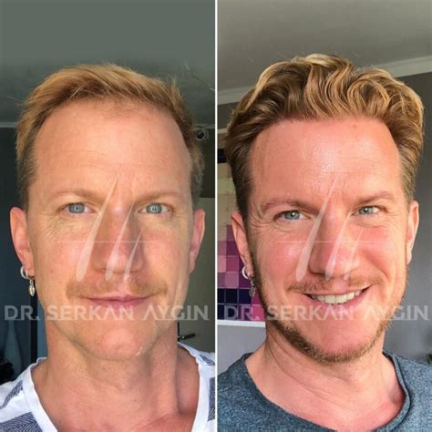 turkey  famous  hair transplant  indiana seery blog