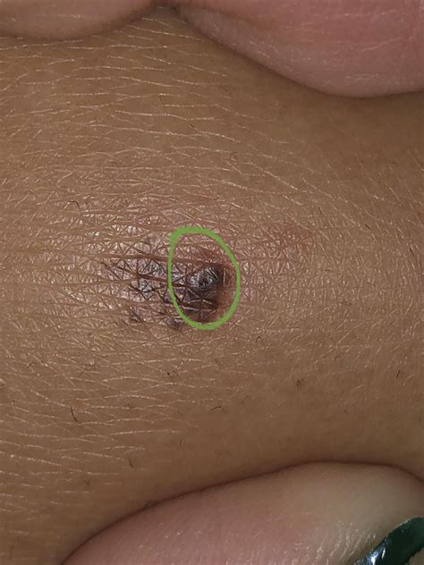 melanoma or just a black head/ingrown hair? (plz read comments