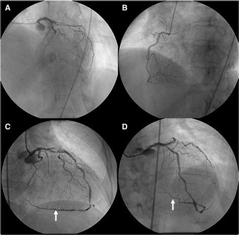 Unusual long left anterior descending coronary artery with a posterior