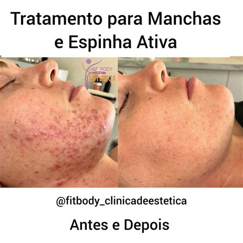 O Que Tira Mancha De Espinha