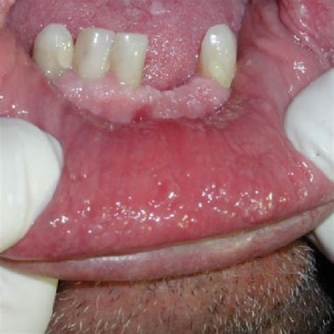 Oral Lesions Under Tongue