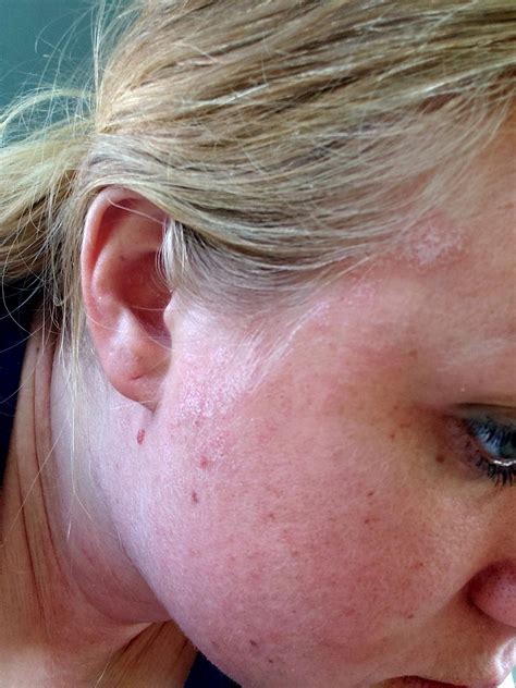 Woke up this morning with swollen knees and new spots. Now on my face