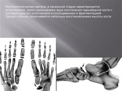 Остеохондропатии и остеодистрофии - презентация онлайн