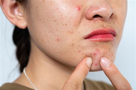 ways  worsen  acne beauty barn blog