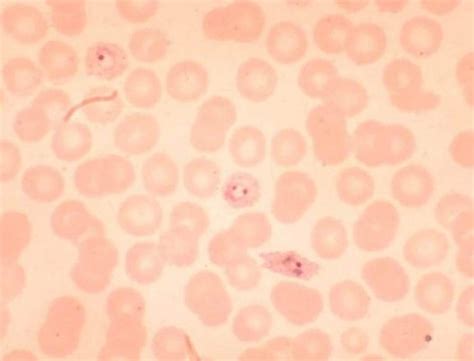 Free picture: plasmodium ovale, young, ring, parasite 