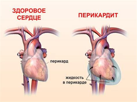 Презентация "Перикардит".