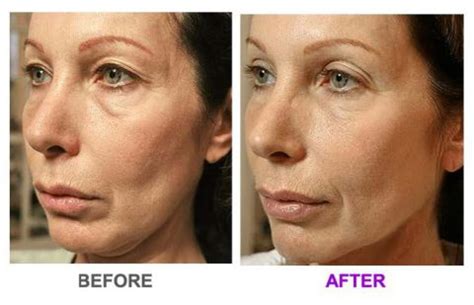 thermage flxcpt dsc laser skin care center