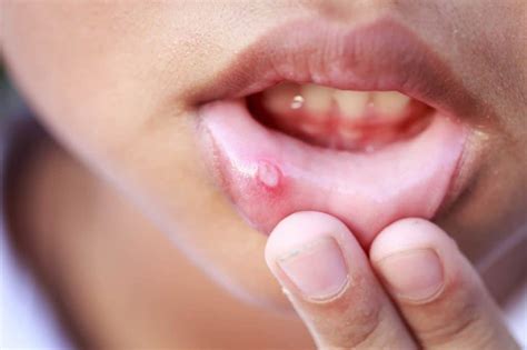 Living With Canker Sores - DentalSave Dental Plans
