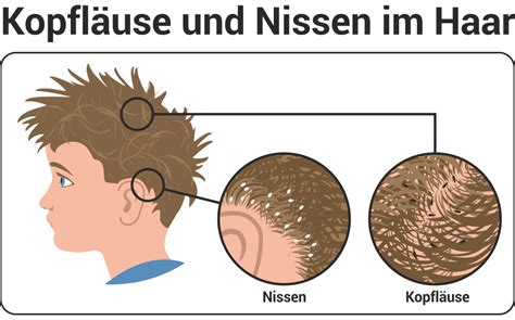 Läuse erkennen, bekämpfen & vorbeugen St. Gangolfs-Apotheke Heinsberg