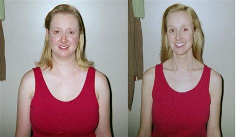 Before/After cure of cushing syndrome (not me) : r/Cushings