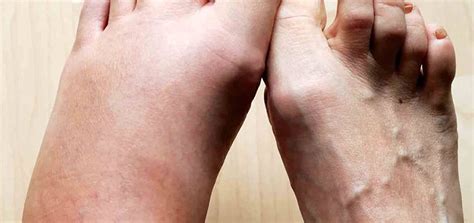 What Does a Bee Sting Look Like? (a Visual Guide) | BeehiveHero